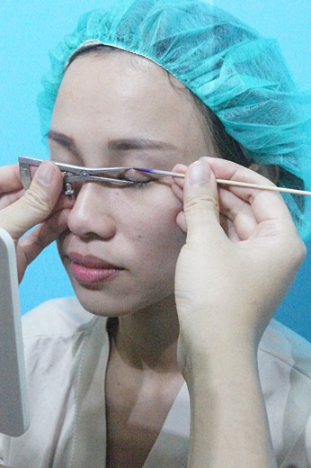 竹東縫雙眼皮醫生