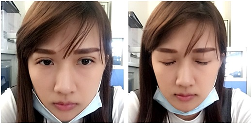 基隆縫雙眼皮醫生