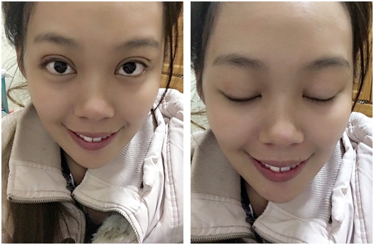 基隆縫雙眼皮醫生