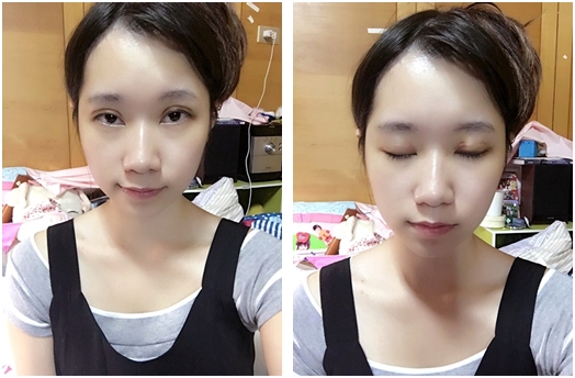 基隆縫雙眼皮醫生