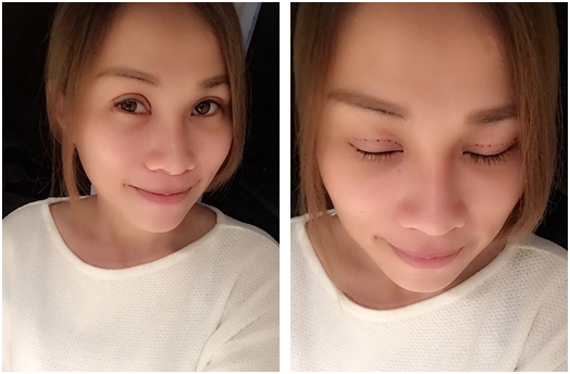 基隆縫雙眼皮醫生