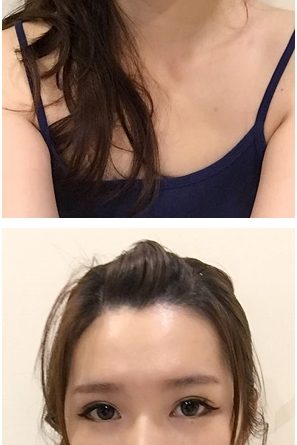 基隆縫雙眼皮醫生