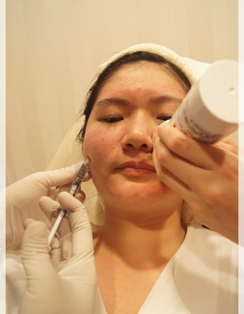 音波拉皮美國機