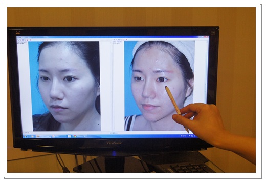 音波拉皮美國機