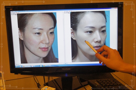 音波拉皮美國機