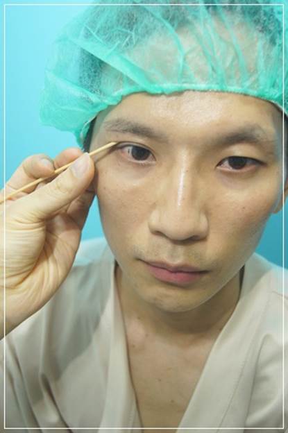 台北雙眼皮手術