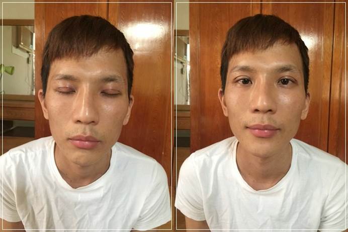 台北韓系縫雙眼皮