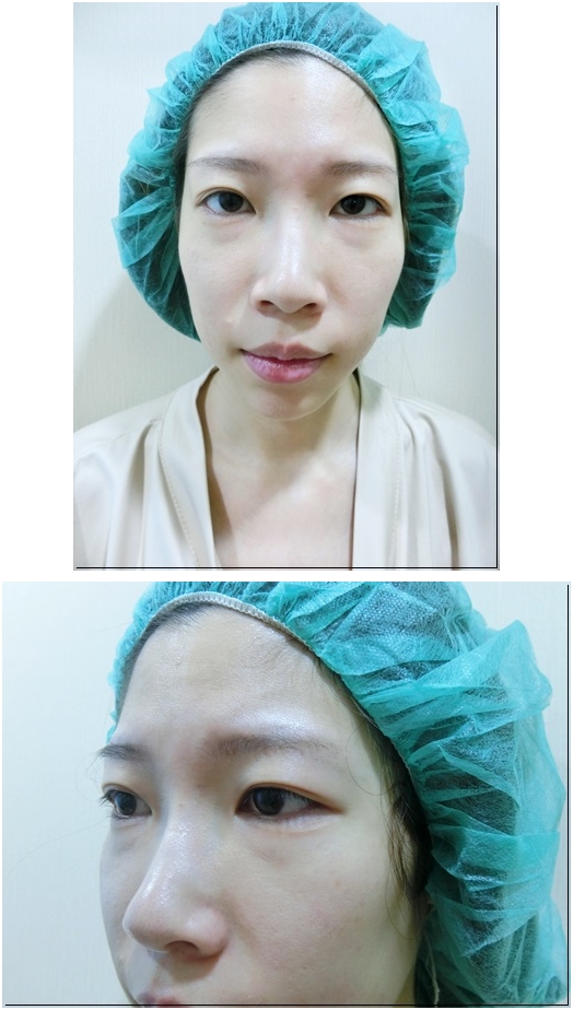 台北韓系縫訂書針雙眼皮推薦