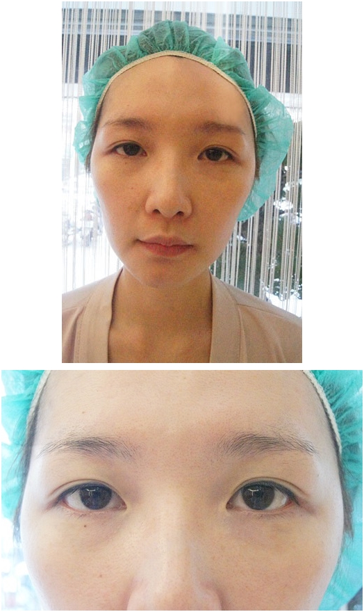 台北韓系縫雙眼皮診所醫師推薦