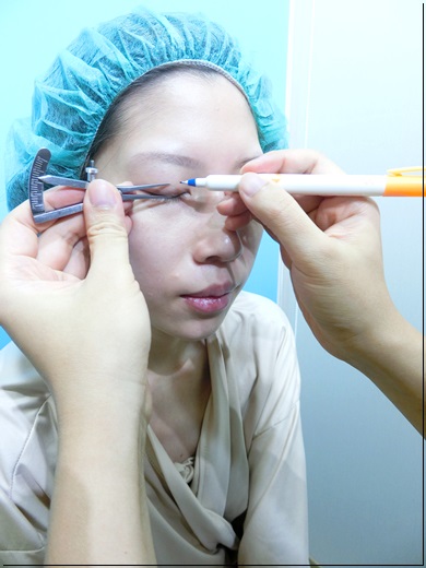 台北韓系無痕割雙眼皮電眼推薦
